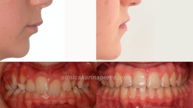 Antes y después perfil con tratamiento en 18 meses. crecimiento maxilar inferior.