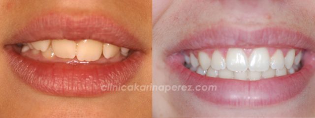 Ortodoncia antes y después, 1 año con aparato funcional y 12 meses con brackets