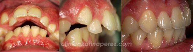 Ortodoncia antes y después, 1 año con aparato funcional y 12 meses con brackets.