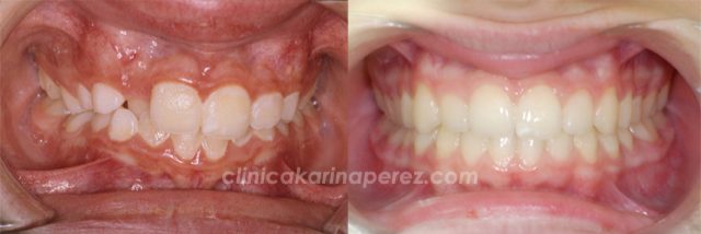 Ortodoncia antes y después de 16 meses de tratamiento