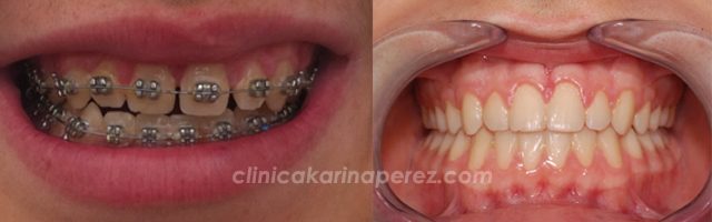 Tratamiento de ortodoncia de 12 meses de duración